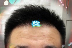 -大麦微针植发全国连锁