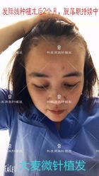 点击看大图 -大麦微针植发丨全国连锁