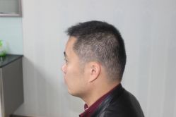 -大麦微针植发丨全国连锁