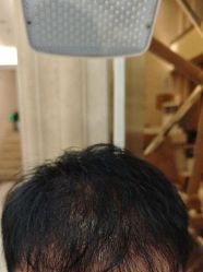 -碧莲盛·不剃发植发