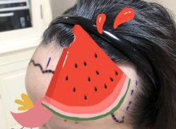 -大麦微针植发全国连锁