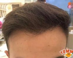 -大麦微针植发全国连锁