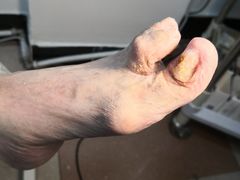 -世龙世家灰指甲鸡眼脚气甲沟炎跖疣护理(通州店)