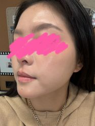 点击看大图 体验后-洁铭新加坡医美