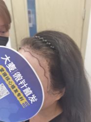 -大麦微针植发全国连锁