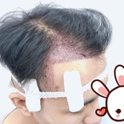 点击看大图 -大麦微针植发丨全国连锁