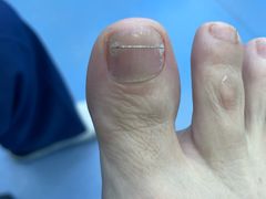 -Andrew指甲专科灰指甲·甲沟炎矫正·3D步态矫形鞋垫定制(浦三路店)