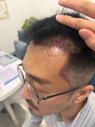 -大麦微针植发全国连锁