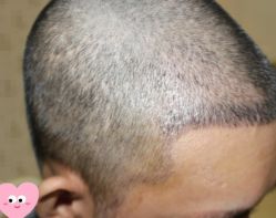 -大麦微针植发丨全国连锁