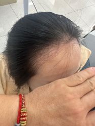 点击看大图 -大麦微针植发丨全国连锁