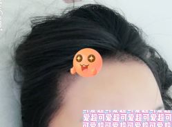 -大麦微针植发全国连锁