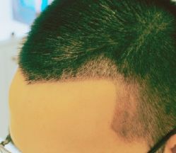-大麦微针植发丨全国连锁