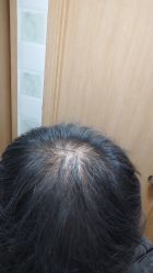 -碧莲盛·不剃发植发