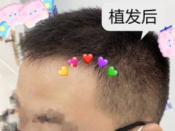 -大麦微针植发全国连锁