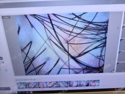 -碧莲盛·不剃发植发