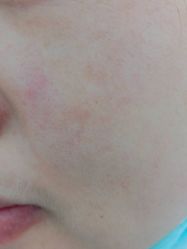 体验前-蕾特恩专业祛痘·皮肤管理