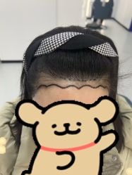 体验前-大麦微针植发全国连锁