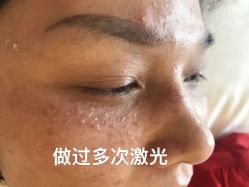 -爱莎扁平疣·汗管瘤·斑痣中心