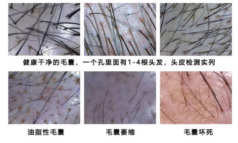 毛囊退化图片