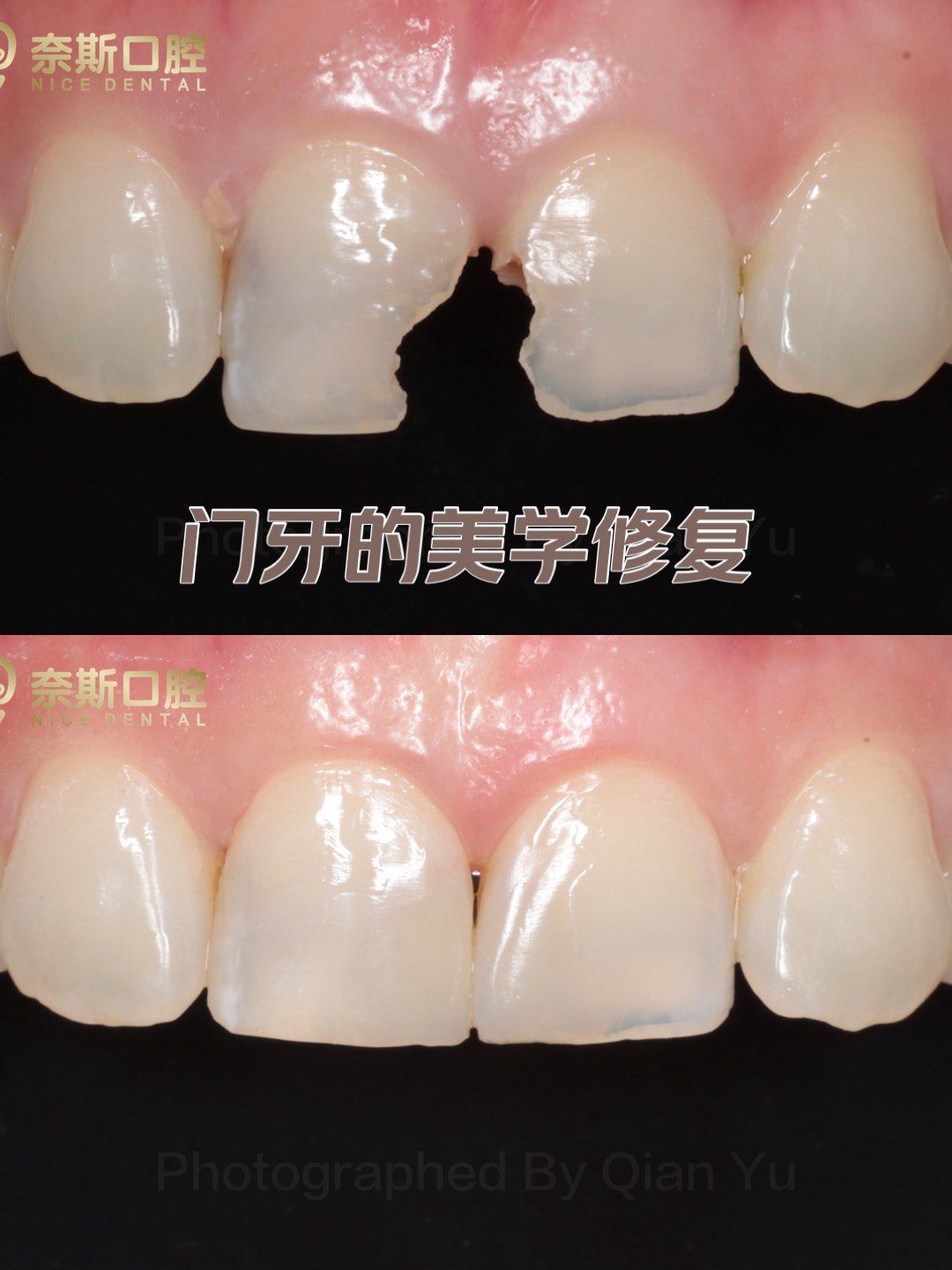 惊艳的门牙美学补牙修复