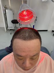 -大麦微针植发全国连锁