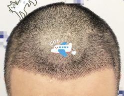 -大麦微针植发全国连锁