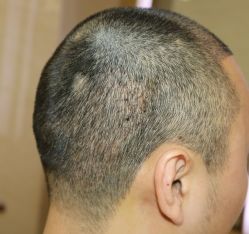 -大麦微针植发全国连锁