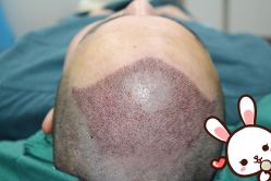 -大麦微针植发丨全国连锁