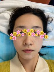 体验后-肌密·水光·祛痘·黄金微针