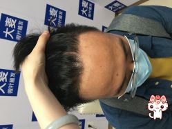 -大麦微针植发丨全国连锁