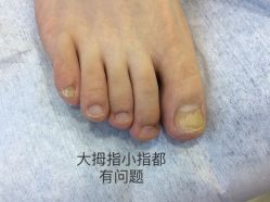 -德哥灰指甲脚气甲沟炎跖疣护理