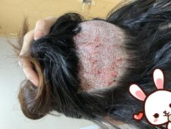 -大麦微针植发丨全国连锁