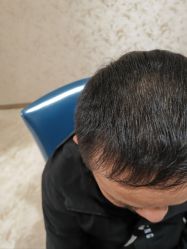 -大麦微针植发丨全国连锁