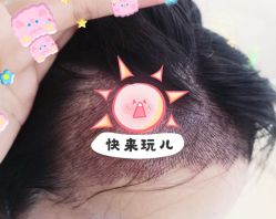 -大麦微针植发全国连锁