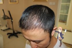 -大麦微针植发丨全国连锁