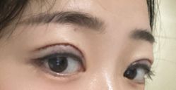 体验后-素美医疗美容·西南眼鼻整形·修复基地