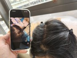 -碧莲盛·不剃发植发