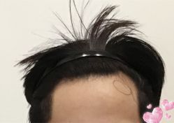 -大麦微针植发全国连锁