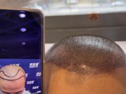 -碧莲盛·不剃发植发