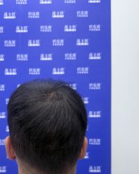 -碧莲盛·不剃发植发