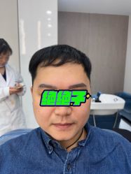 -大麦微针植发全国连锁