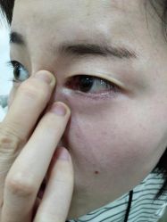-北京美痣堂古方祛痣斑疣瘊