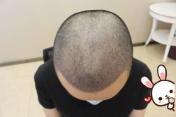 -大麦微针植发丨全国连锁