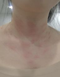 -爱莎扁平疣·汗管瘤·斑痣中心