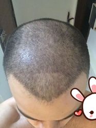 -大麦微针植发丨全国连锁