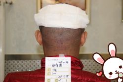 点击看大图 -大麦微针植发丨全国连锁