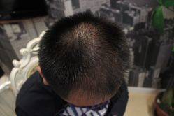 点击看大图 -大麦微针植发丨全国连锁