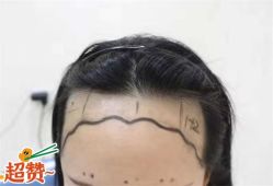 -大麦微针植发全国连锁