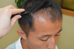 -大麦微针植发丨全国连锁