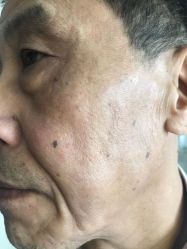 -美丽人生祛斑扁平疣汗管瘤中心